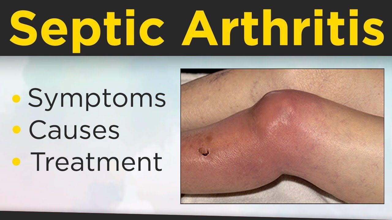 😱 What is Septic Arthritis? 💹Septic Arthritis Symptoms, Causes, Risk Factors And Treatment